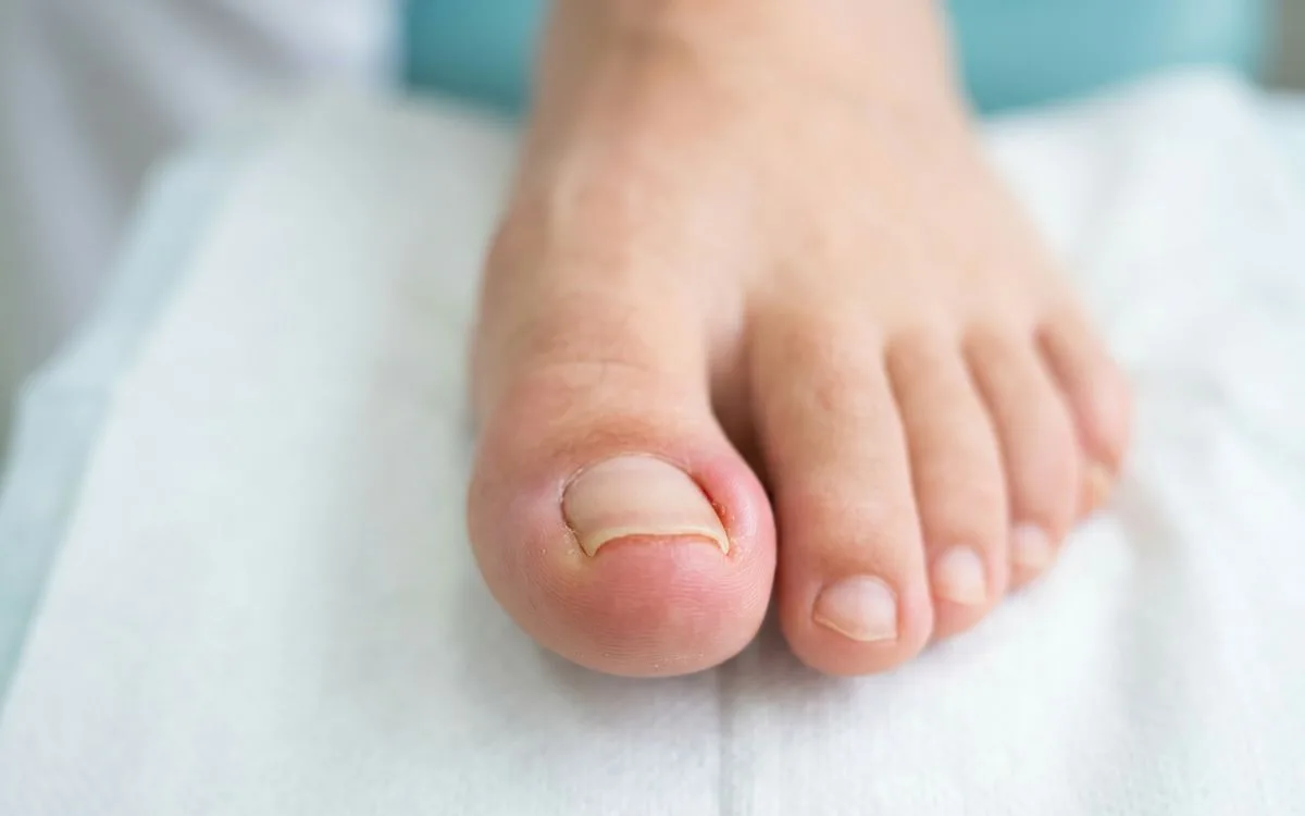 Dedo gordo del pie con uña encarnada: el borde de la uña se mete en la piel y el pliegue está inflamado por encima